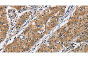 Immunohistochemistry of paraffin-embedded Human gastric cancer using COPB1 Polyclonal Antibody at dilution of 1:50 (COPB1 antibody)