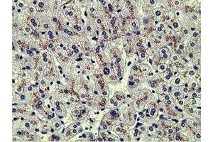 Immunohistochemical staining of paraffin-embedded Human liver tissue using anti-AFP mouse monoclonal antibody. (alpha Fetoprotein antibody)