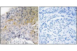 Immunohistochemical analysis of paraffin-embedded human breast carcinoma tissue using p130 Cas (Ab-410) antibody. (BCAR1 antibody)