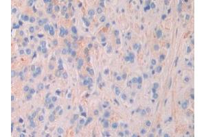 DAB staining on IHC-P; Samples: Human Prostate cancer Tissue (MEPE antibody  (AA 212-445))