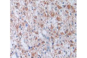 IHC-P analysis of glioma tissue, with DAB staining.