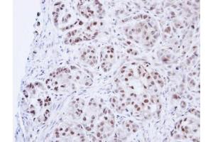 IHC-P Image Immunohistochemical analysis of paraffin-embedded A549 Xenograft, using DNA ligase 3, antibody at 1:100 dilution. (LIG3 antibody)