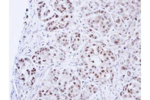 IHC-P Image Immunohistochemical analysis of paraffin-embedded A549 Xenograft, using DNA ligase 3, antibody at 1:100 dilution.