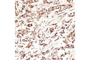 Immunohistochemistry of paraffin-embedded human breast cancer using KLHL9 antibody (ABIN6132083, ABIN6142940, ABIN6142941 and ABIN6214299) at dilution of 1:100 (40x lens).