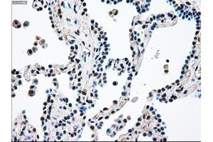 Immunohistochemical staining of paraffin-embedded Adenocarcinoma of breast tissue using anti-MAP2K4 mouse monoclonal antibody. (MAP2K4 antibody)