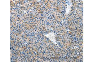 Immunohistochemistry of Human liver cancer using EPHB3 Polyclonal Antibody at dilution of 1:50 (EPH Receptor B3 antibody)