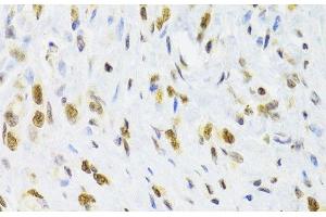 Immunohistochemistry of paraffin-embedded Human gastric cancer using DOK1 Polyclonal Antibody at dilution of 1:100 (40x lens). (DOK1 antibody)