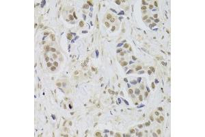 Immunohistochemistry of paraffin-embedded human breast cancer using UBE3C Antibody (ABIN5973842) at dilution of 1/100 (40x lens). (UBE3C antibody)