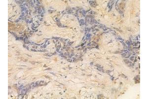 ABIN6261139 and ABIN6266523 at 1/100 staining human breast carcinoma by IHC-P. (Cyclin A1 antibody  (C-Term))