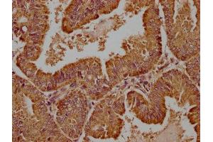 IHC image of ABIN7175790 diluted at 1:100 and staining in paraffin-embedded human endometrial cancer performed on a Leica BondTM system. (WDR73 antibody  (AA 163-366))