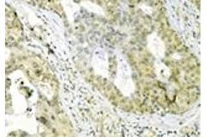 Immunohistochemistry analysis of human breast cancer tissue immunohistochemically stained using Grp75 mAb (30A5). (HSPA9 antibody)