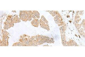 Immunohistochemistry of paraffin-embedded Human liver cancer tissue using PSMA4 Polyclonal Antibody at dilution of 1:50(x200) (PSMA4 antibody)