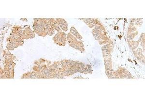 Immunohistochemistry of paraffin-embedded Human liver cancer tissue using PSMA4 Polyclonal Antibody at dilution of 1:50(x200)