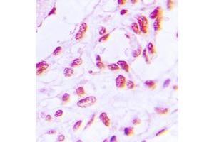 Immunohistochemical analysis of RB1 (pS780) staining in human breast cancer formalin fixed paraffin embedded tissue section. (Retinoblastoma 1 antibody  (C-Term, pSer780))