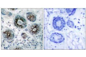 Immunohistochemical analysis of paraffin-embedded human breast carcinoma tissue, using GAP43 (Ab-41) antibody (E021273). (GAP43 antibody)