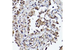 Immunohistochemistry of paraffin-embedded human lung cancer using PHD3 Rabbit pAb (ABIN6130355, ABIN6139990, ABIN6139991 and ABIN6224021) at dilution of 1:150 (40x lens). (EGLN3 antibody  (AA 1-120))