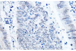 Immunohistochemistry of paraffin-embedded Human colon carcinoma using ADAR Polyclonal Antibody at dilution of 1:100 (40x lens).