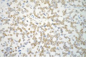 Immunohistochemistry was performed on paraffin-embedded human prostatic adenocarcinoma using androgen receptor antibody (ABIN7797599), 1:200).
