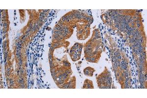 Immunohistochemistry of paraffin-embedded Human gasrtic cancer tissue using ACP6 Polyclonal Antibody at dilution 1:50 (ACP6 antibody)