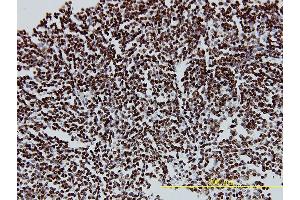 Immunoperoxidase of monoclonal antibody to CUTL1 on formalin-fixed paraffin-embedded human malignant lymphoma, diffuse large B tissue. (CUX1 antibody  (AA 521-620))