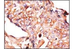 Formalin-fixed and paraffin-embedded human breast carcinoma reacted with anti-NP1(Nptx1) Antibody (Center), which was peroxidase-conjugated to the secondary antibody, followed by DAB staining. (NPX1 antibody  (AA 174-203))