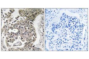Immunohistochemistry analysis of paraffin-embedded human breast carcinoma tissue using PPP2R1B antibody. (PPP2R1B antibody  (C-Term))