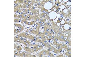 Immunohistochemistry of paraffin-embedded human liver injury using HYAL1 antibody (ABIN5975045) at dilution of 1/100 (40x lens). (HYAL1 antibody)