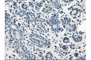 Immunohistochemical staining of paraffin-embedded breast tissue using anti-IDH1 mouse monoclonal antibody. (IDH1 antibody)