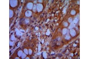 Immunohistochemical analysis of paraffin-embedded colon cancer tissues using CHD3 mouse mAb with DAB staining. (CHD3 antibody)