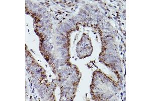 Immunohistochemistry of paraffin-embedded human colon carcinoma using GOLGB1 Rabbit pAb (ABIN7267498) at dilution of 1:100 (40x lens). (Golgin B1 (GOLGB1) antibody)