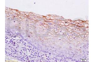Formalin-fixed and paraffin embedded human breast carcinoma labeled with Anti-pan Cytokeratin Polyclonal Antibody, Unconjugated  at 1:200 followed by conjugation to the secondary antibody and DAB staining. (pan Keratin antibody  (AA 331-430))