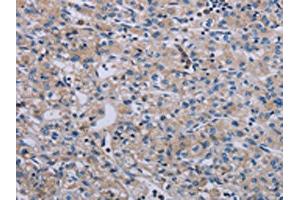 The image on the left is immunohistochemistry of paraffin-embedded Human prostate cancer tissue using ABIN7191769(PAGE4 Antibody) at dilution 1/40, on the right is treated with synthetic peptide. (PAGE4 antibody)
