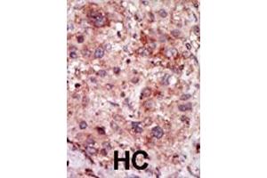 Formalin-fixed and paraffin-embedded human cancer tissue reacted with the primary antibody, which was peroxidase-conjugated to the secondary antibody, followed by DAB staining. (GAK antibody  (N-Term))