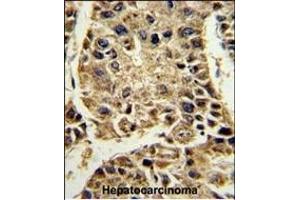Formalin-fixed and paraffin-embedded human hepatocarcinoma reacted with SERPINA4 Antibody (C-term), which was peroxidase-conjugated to the secondary antibody, followed by DAB staining.