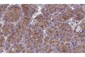 ABIN6273986 at 1/100 staining Human liver cancer tissue by IHC-P. (OR2W1 antibody  (C-Term))