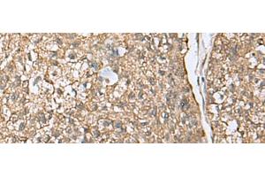 Immunohistochemistry of paraffin-embedded Human esophagus cancer tissue using EIF4A2 Polyclonal Antibody at dilution of 1:65(x200) (EIF4A2 antibody)