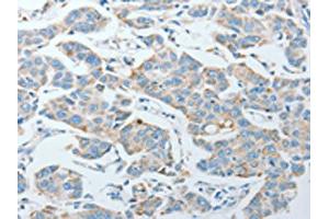 The image on the left is immunohistochemistry of paraffin-embedded Human lung cancer tissue using ABIN7128282(AGA Antibody) at dilution 1/20, on the right is treated with fusion protein. (AGA antibody)