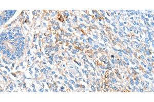 Immunohistochemistry of paraffin-embedded Human ovarian cancer using ALDH1A2 Polyclonal Antibody at dilution of 1:60 (ALDH1A2 antibody)