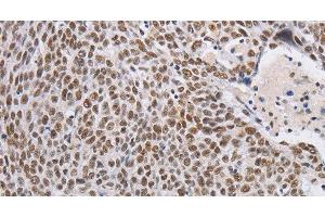 Immunohistochemistry of paraffin-embedded Human lung cancer using THOC7 Polyclonal Antibody at dilution of 1:30 (THOC7 antibody)