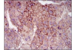Immunohistochemical analysis of paraffin-embedded liver cancer tissues using MELK mouse mAb with DAB staining. (MELK antibody  (AA 637-651))