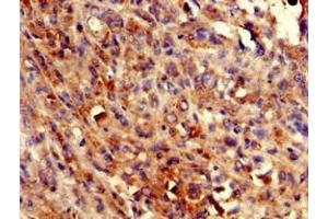 Immunohistochemistry of paraffin-embedded human melanoma using ABIN7145071 at dilution of 1:100 (COQ8B antibody  (AA 10-137))