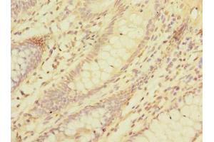 Immunohistochemistry of paraffin-embedded human colon cancer using ABIN7158359 at dilution of 1:100 (LMO3 antibody  (AA 1-145))