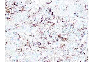 Immunohistochemistry of paraffin-embedded human liver cancer using Cathepsin L/V/K/H Rabbit mAb (ABIN7266150) at dilution of 1:100 (40x lens). (Cathepsin L antibody)