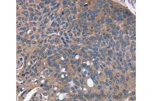 Immunohistochemistry of Human esophagus cancer using RGS4 Polyclonal Antibody at dilution of 1:30 (RGS4 antibody)