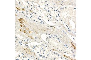 Immunohistochemistry of paraffin-embedded human prostate cancer using MMP7 Rabbit mAb (ABIN7268425) at dilution of 1:150 (40x lens). (MMP7 antibody)
