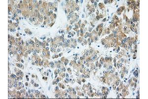 Immunohistochemical staining of paraffin-embedded Adenocarcinoma of Human ovary tissue using anti-H6PD mouse monoclonal antibody.
