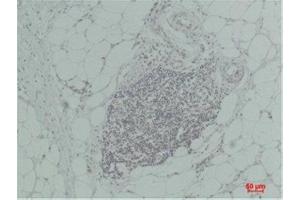 Immunohistochemistry (IHC) analysis of paraffin-embedded Human Breast Carcinoma using TNF a Rabbit Polyclonal Antibody diluted at 1:200. (TNF alpha antibody)