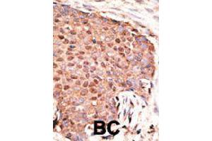 Formalin-fixed and paraffin-embedded human cancer tissue reacted with ZMIZ1 polyclonal antibody  , which was peroxidase-conjugated to the secondary antibody, followed by AEC staining.