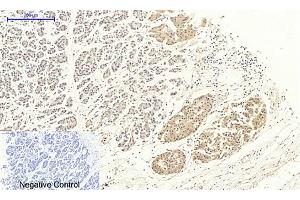 Immunohistochemical analysis of paraffin-embedded human stomach cancer tissue. (Dynamin 1-Like antibody)