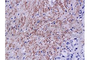 Formalin-fixed and paraffin embedded human prostate tissue labeled with Anti-Androgen receptor Polyclonal Antibody, Unconjugated (ABIN725240) at 1:200, followed by conjugation to the secondary antibody and DAB staining (Androgen Receptor antibody  (AA 825-919))